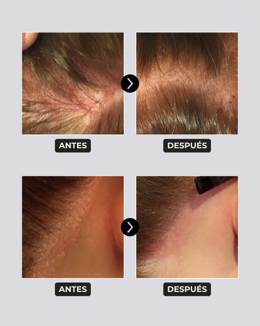 Pack Caspa Seca y Psoriasis: Shampoo Detox Hidratante en barra + Tónico Calmante 100 ml | Para caspa seca, picazón o brotes