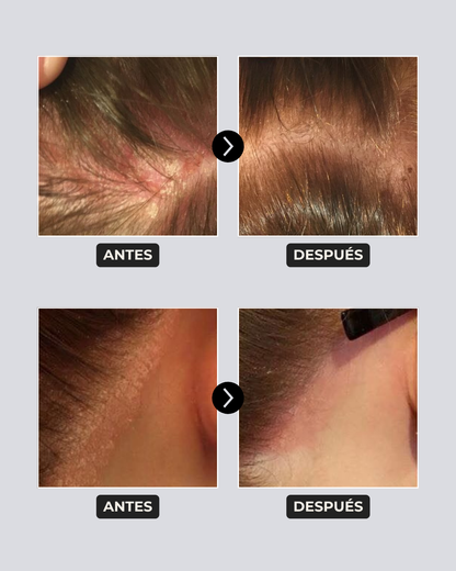 Pack Caspa Seca y Psoriasis: Shampoo Detox Hidratante en barra + Tónico Calmante 100 ml | Para caspa seca, picazón o brotes