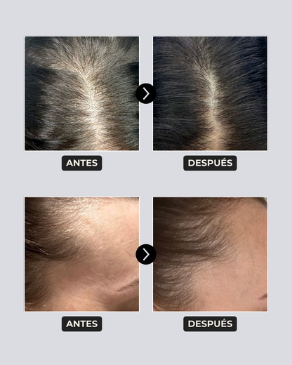 Pack Anticaspa | Shampoo 300 ml + Acondicionador 300 ml